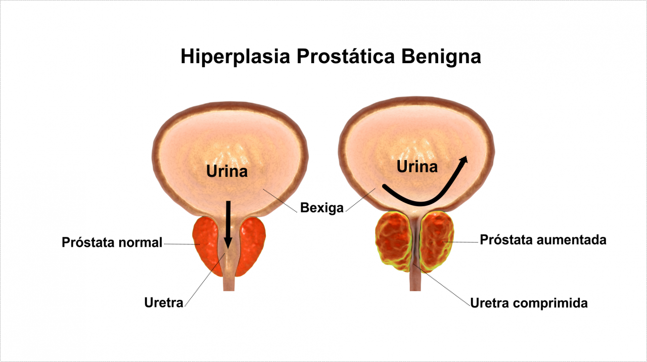 O Que É Hiperplasia Prostática Benigna Clínica Afetus 8621