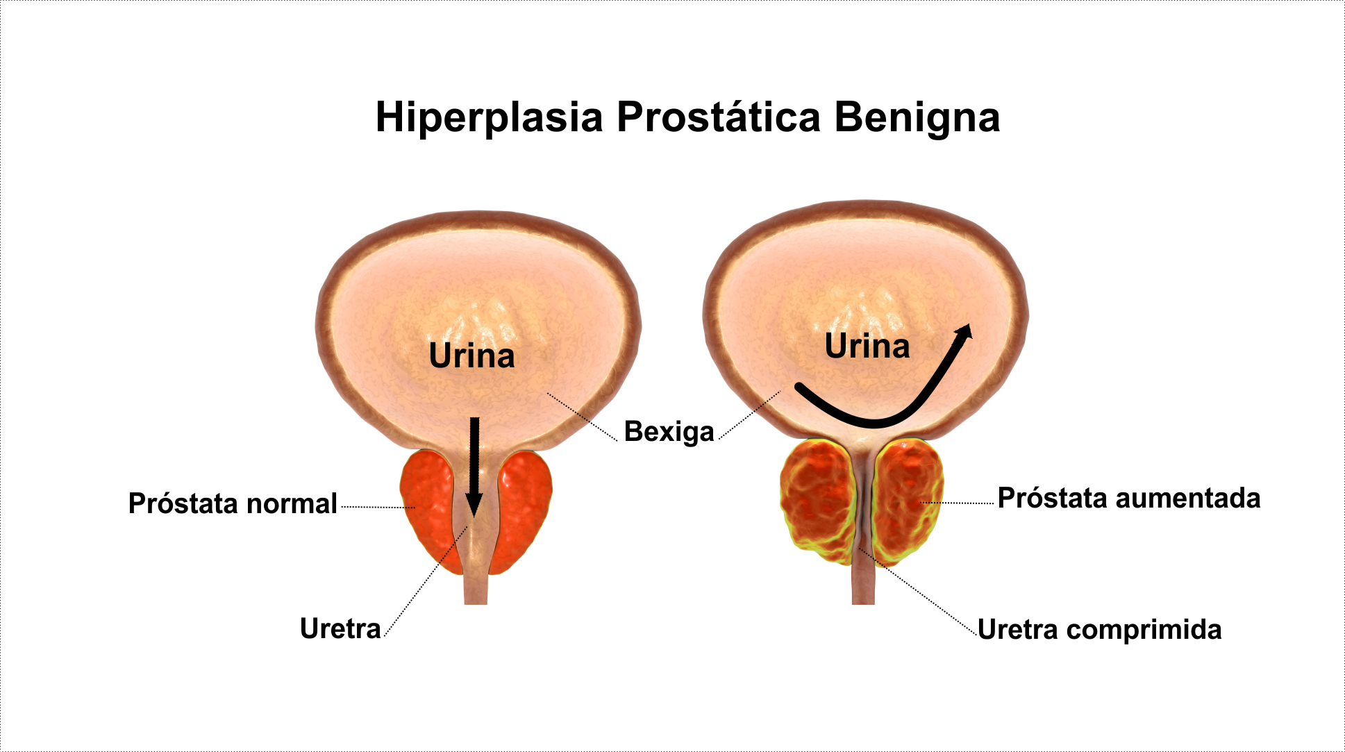 Psa hiperplazia benigna prostata