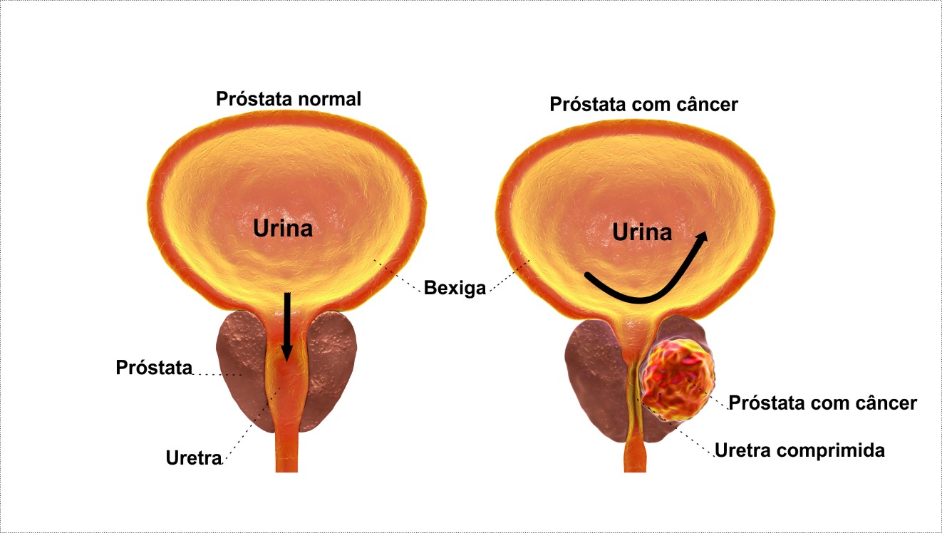 Cancer de uretra hombre sintomas