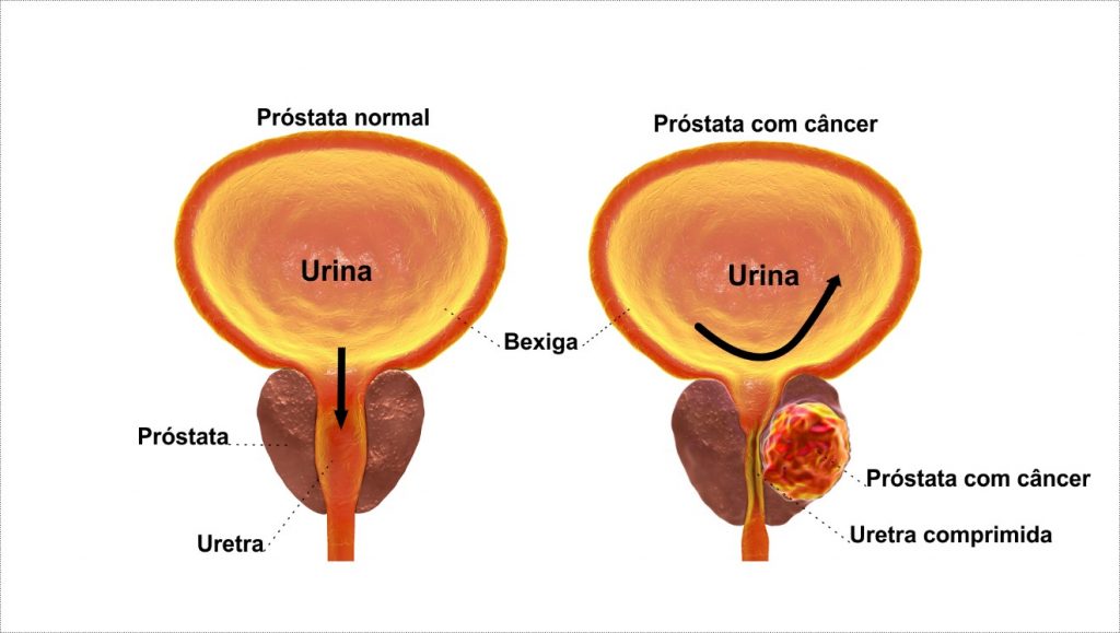 Câncer De Próstata Definições E Sintomas Clínica Afetus 0334